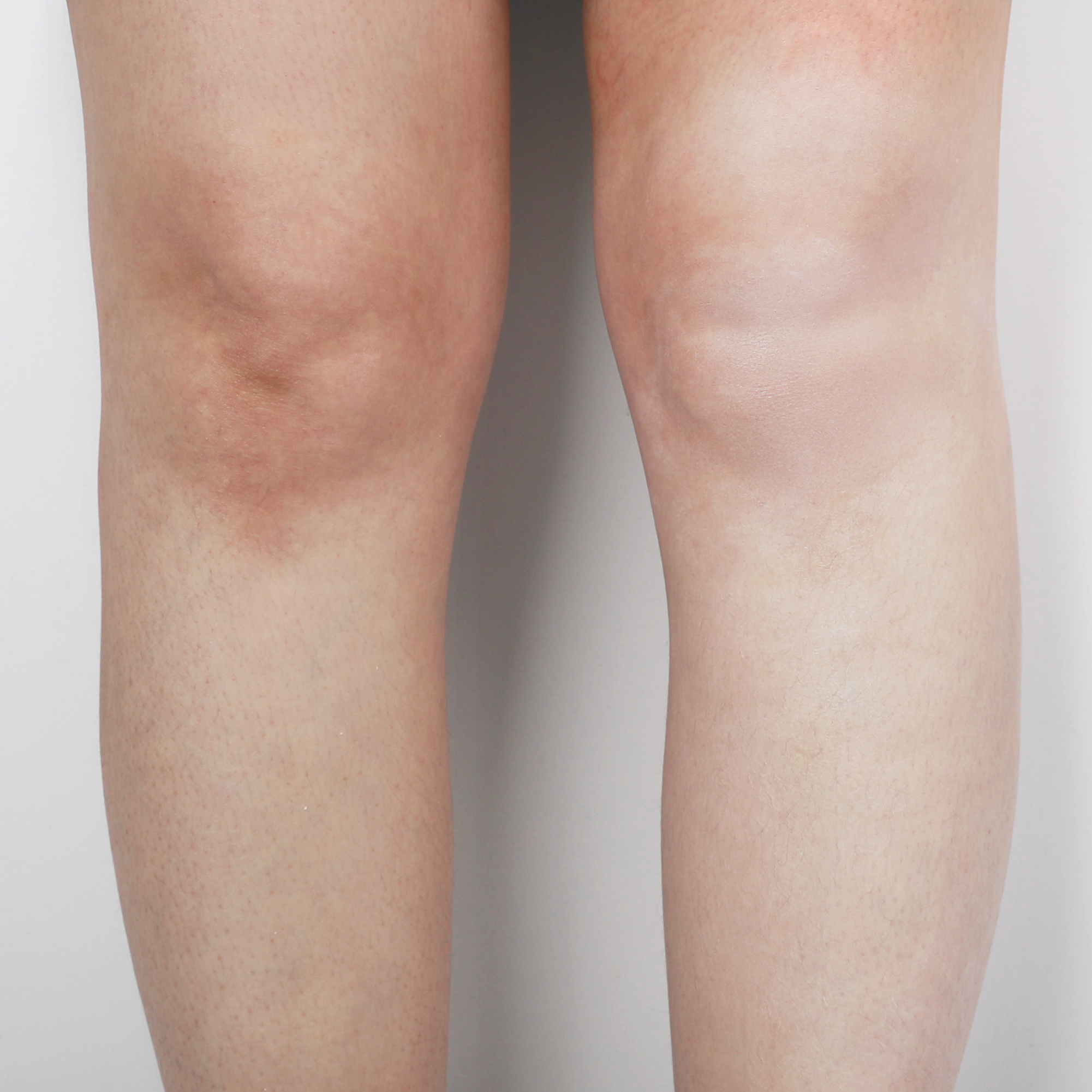 Close-up of a person's legs with visible difference of tones and shades on a plain background